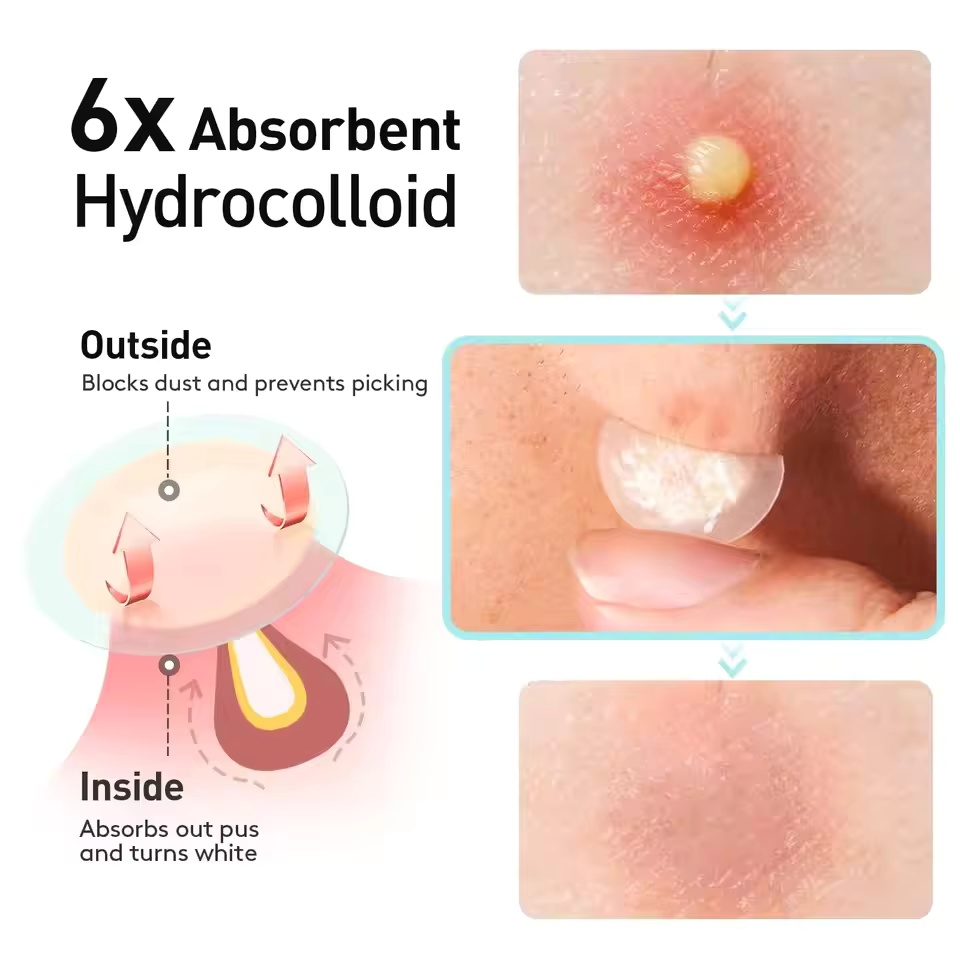 360枚/箱 ニキビパッチ - アルコールフリー、ニキビの分 - Essential Oils のレビューと価格